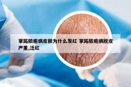 掌跖脓疱病皮肤为什么发红 掌跖脓疱病脱皮严重,泛红