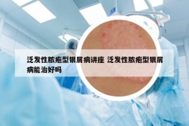 泛发性脓疱型银屑病讲座 泛发性脓疱型银屑病能治好吗