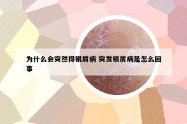 为什么会突然得银屑病 突发银屑病是怎么回事