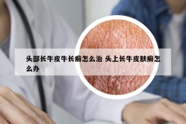 头部长牛皮牛长癣怎么治 头上长牛皮肤癣怎么办