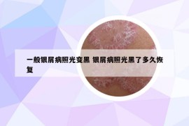 一般银屑病照光变黑 银屑病照光黑了多久恢复