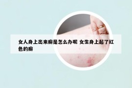 女人身上出来癣是怎么办呢 女生身上起了红色的癣