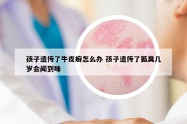 孩子遗传了牛皮癣怎么办 孩子遗传了狐臭几岁会闻到味