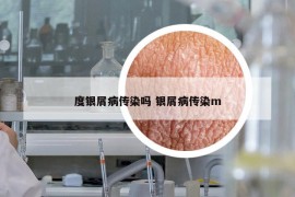 度银屑病传染吗 银屑病传染m