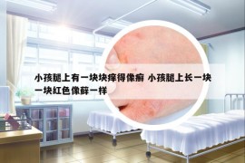 小孩腿上有一块块痒得像癣 小孩腿上长一块一块红色像藓一样