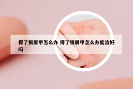 得了银屑甲怎么办 得了银屑甲怎么办能治好吗