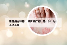 银屑病协和打针 银屑病打的针是什么针为什么这么贵