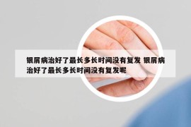 银屑病治好了最长多长时间没有复发 银屑病治好了最长多长时间没有复发呢