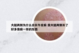 大腿两侧为什么会长牛皮癣 我大腿两侧长了好多像癣一样的东西