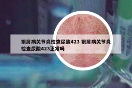 银屑病关节炎检查尿酸423 银屑病关节炎检查尿酸423正常吗