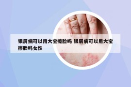 银屑病可以用大宝擦脸吗 银屑病可以用大宝擦脸吗女性