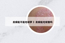 皮癣能不能吃胡萝卜 皮癣能吃螃蟹吗