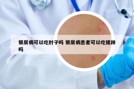 银屑病可以吃肘子吗 银屑病患者可以吃猪蹄吗