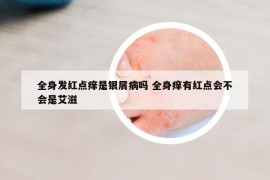 全身发红点痒是银屑病吗 全身痒有红点会不会是艾滋