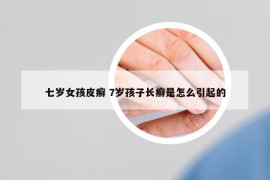 七岁女孩皮癣 7岁孩子长癣是怎么引起的