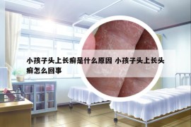 小孩子头上长癣是什么原因 小孩子头上长头癣怎么回事