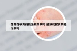 醋熬花椒真的能治银屑病吗 醋熬花椒真的能治癣吗