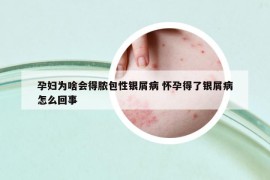 孕妇为啥会得脓包性银屑病 怀孕得了银屑病怎么回事