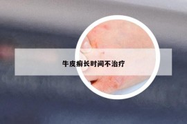 牛皮癣长时间不治疗