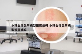 小孩会得关节病型银屑病吗 小孩会得关节病型银屑病吗