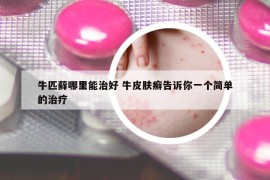 牛匹藓哪里能治好 牛皮肤癣告诉你一个简单的治疗