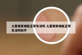 儿童银屑病能正常生活吗 儿童银屑病能正常生活吗知乎