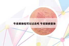 牛皮癣体检可以过去吗 牛皮肤癣查体