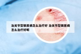 治关节型银屑病怎么治疗好 治关节型银屑病怎么治疗好呢