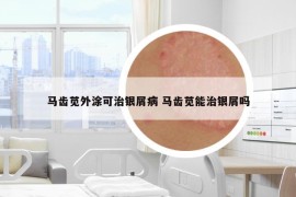 马齿苋外涂可治银屑病 马齿苋能治银屑吗