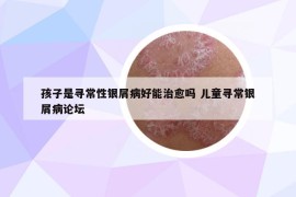 孩子是寻常性银屑病好能治愈吗 儿童寻常银屑病论坛