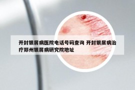 开封银屑病医院电话号码查询 开封银屑病治疗郑州银屑病研究院地址