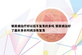 银屑病治疗好以后不复发的多吗 银屑病治好了最长多长时间没有复发