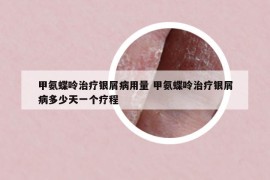 甲氨蝶呤治疗银屑病用量 甲氨蝶呤治疗银屑病多少天一个疗程