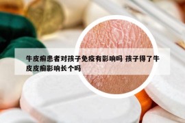 牛皮癣患者对孩子免疫有影响吗 孩子得了牛皮皮癣影响长个吗