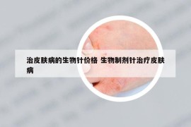 治皮肤病的生物针价格 生物制剂针治疗皮肤病