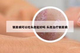 银屑病可以吃头孢能好吗 头孢治疗银屑病