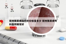 郑州银屑病治疗的价格是多少 郑州银屑病专科医院哪家好