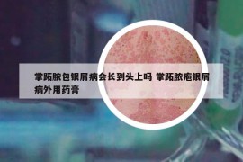 掌跖脓包银屑病会长到头上吗 掌跖脓疱银屑病外用药膏