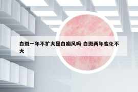 白斑一年不扩大是白癜风吗 白斑两年变化不大