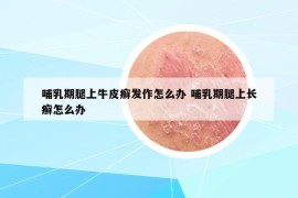 哺乳期腿上牛皮癣发作怎么办 哺乳期腿上长癣怎么办