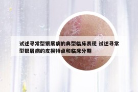 试述寻常型银屑病的典型临床表现 试述寻常型银屑病的皮损特点和临床分期