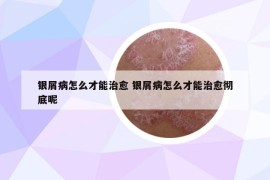 银屑病怎么才能治愈 银屑病怎么才能治愈彻底呢