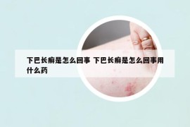 下巴长癣是怎么回事 下巴长癣是怎么回事用什么药