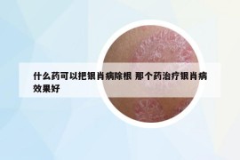 什么药可以把银肖病除根 那个药治疗银肖病效果好