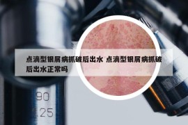 点滴型银屑病抓破后出水 点滴型银屑病抓破后出水正常吗