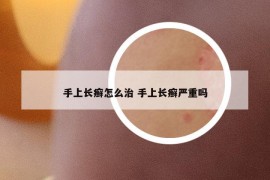 手上长癣怎么治 手上长癣严重吗