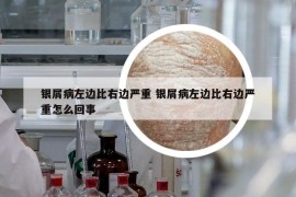 银屑病左边比右边严重 银屑病左边比右边严重怎么回事