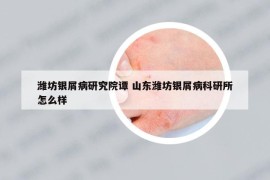 潍坊银屑病研究院谭 山东潍坊银屑病科研所怎么样