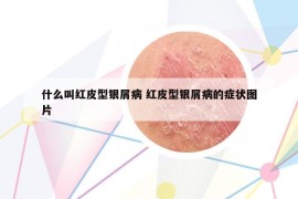 什么叫红皮型银屑病 红皮型银屑病的症状图片