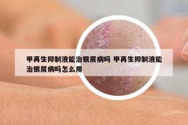 甲再生抑制液能治银屑病吗 甲再生抑制液能治银屑病吗怎么用